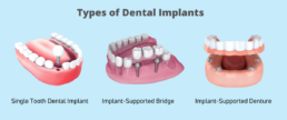 Types Of Dental Implants