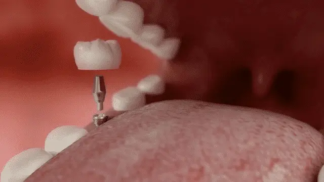 Same day dental implant